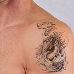 Tatuoinnin poisto laserilla Tatuoinnin poisto laserilla