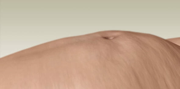 Rasvaimu BodyTite