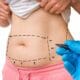 abdominoplastia plastiikkakirurgi Riikka Veltheim