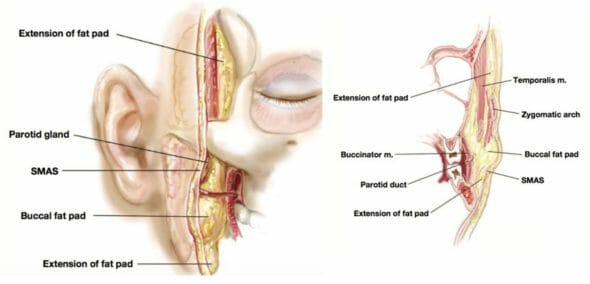 Buccal fat pad removal - posken rasvan sijainti