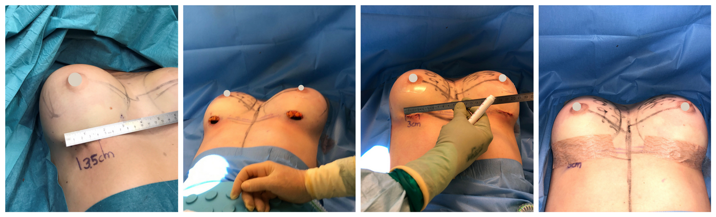Rintaimplantit short scar