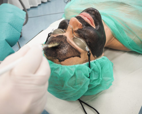 hollywood-black-laser-peel-hiililiuoksen-levittaminen